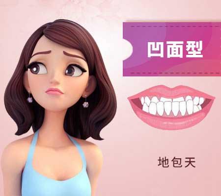 什么是地包天？地包天長什么樣子？地包天牙齒圖片