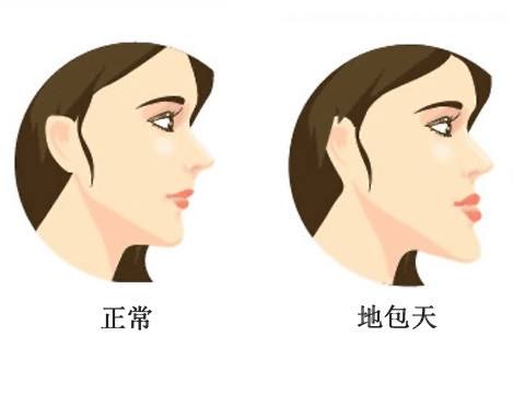 什么是地包天？地包天長什么樣子？地包天牙齒圖片