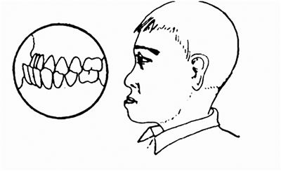 什么是地包天？地包天長什么樣子？地包天牙齒圖片