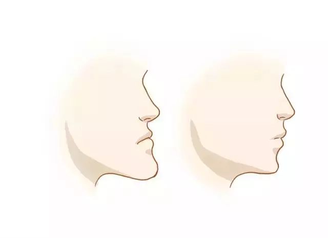 什么是地包天？地包天長什么樣子？地包天牙齒圖片